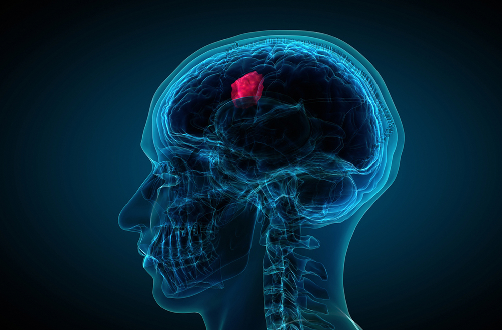 Is End Stage Glioblastoma Painful Fritz Wilt